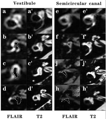 Vestibular Endolymphatic Hydrops Visualized by Magnetic Resonance Imaging and Its Correlation With Vestibular Functional Test in Patients With Unilateral Meniere's Disease